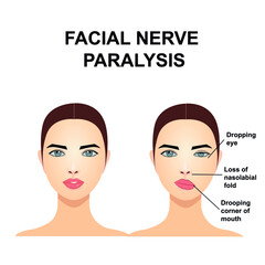 Obraz premium Paralysis of the facial nerve. Bell's palsy.