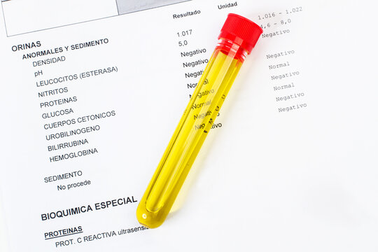 Tubo de ensayo para examen de orina sobre un informe de laboratorio. Vista superior. Concepto: Salud