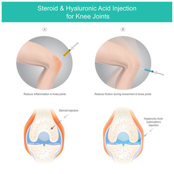 Steroid & Hyaluronic Acid Injection for Knee Joints. Illustration explain the steroid fluid and the hyaluronic acid fluid for use injection knee joints treatment symptoms
