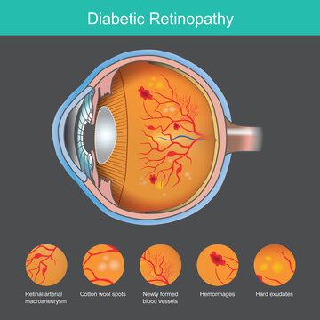 Diabetic Retinopathy. Illustration abnormality the retina from symptoms the diabetic retinopathy..
