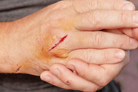 Man's hand with a cut wound, a cut hand