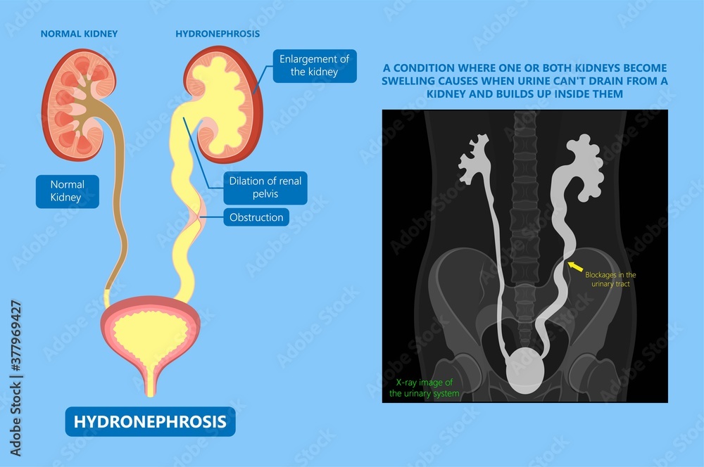 Poster kidney damage uti scan test tube vcug acute vur cyst exam flow pain birth block blood fetal fetus re