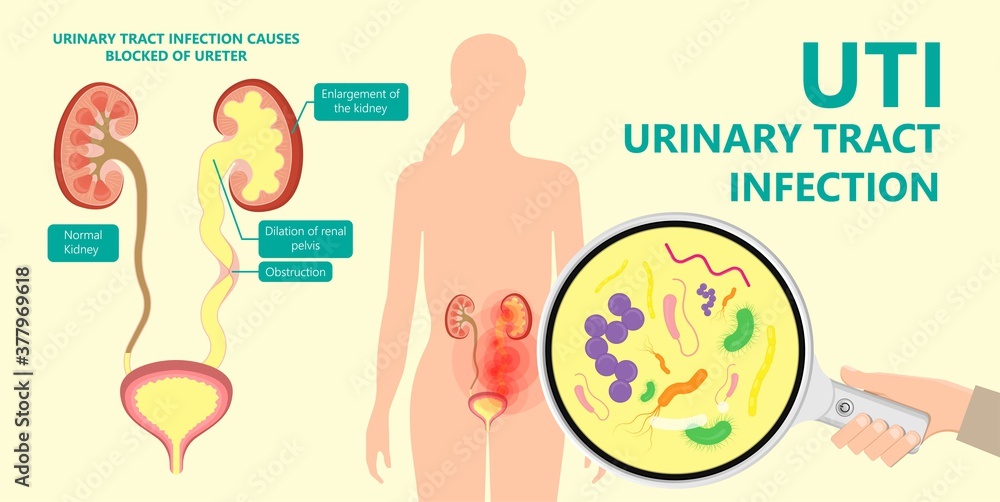 Poster kidney damage uti scan test tube vcug acute vur cyst exam flow pain birth block blood fetal fetus re