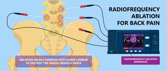 RFA low arm leg hip pain back neck knee pars bone nerve treat joint spine block Local radio needle relief branch Lumbar spinal damage pelvis therapy lateral chronic vertebra cervical surgical medial