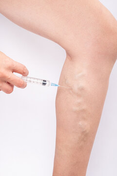 varicose vein treatment, injection into a sore leg

