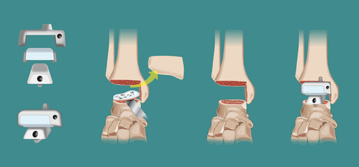 Ankle arthroplasty