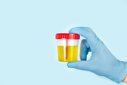 Mano del m&eacute;dico sosteniendo una muestra de orina dentro de un recipiente de pl&aacute;stico sobre un fondo celeste iso y aislado. Vista de frente. Copy space. Concepto: Salud Medicina