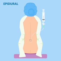 Epidural spinal block anaesthesia Pinched relieve General vaginal medical steroid Natural surgery Walking opioids baby pain back cord birth labor women local spine space relief labour section giving - obrazy, fototapety, plakaty