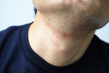 Obraz premium 髭剃り後の肌荒れに悩む日本人男性のクローズアップ