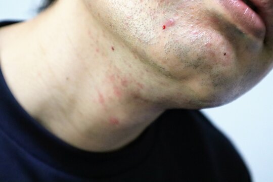 カミソリ負け の画像 291 件の Stock 写真 ベクターおよびビデオ Adobe Stock