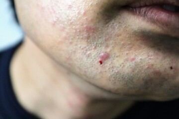 髭剃り後の肌荒れに悩む男性のクローズアップ