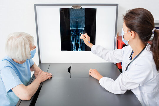 Rheumatologist consulting an elderly patient by pointing to X-ray of knee joint. Arthritis and disease of the joints of the legs