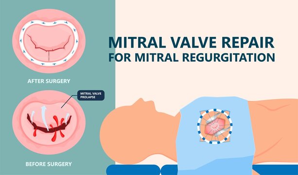 Cath Lab Atrial Septal Defect Tetralogy Of Fallot Patent Foramen Ovale Mitral Valve Stenosis Heart Attack Ductus Arteriosus Doppler Coronary Artery Disease Congestive Congenital Valvular VSD Exam Leak