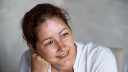 Portrait of a smiling woman with a pigmented spot on her forehead. Girl with Vitiligo Disease.