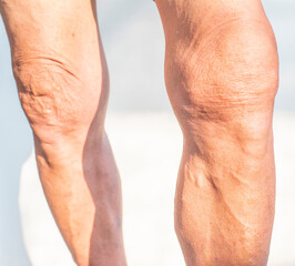 Poor knee joints of the elderly with muscular inflammation and osteoarthritis.