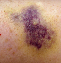 Purple bruise on human skin