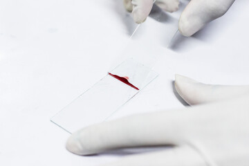smear drawing of blood by glass slide
