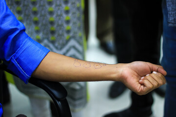 skin allergy test preparation by doctor on a patient hand using allergy sensitivity kit