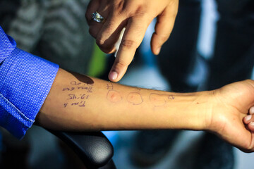 skin allergy test preparation by doctor on a patient hand showing the allergic hypersensitivity reaction wheal swelling