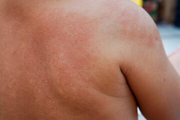Naklejka premium the skin on the back of the baby is red and peeling. asian baby. psoriasis. suitable for skin health purposes. shallow focus depth of field