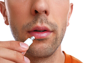 Naklejka premium Young man with cold sore applying cream on lips against white background, closeup