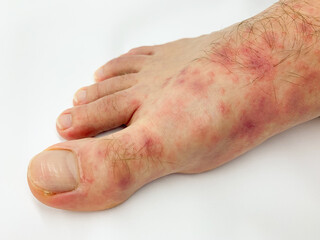 Close up of male's foot and toes with red rash desease on a white background.
