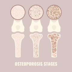 Osteoporosis disease stages from healthy to severe. Bone density loss infographic banner. Normal bone becoming osteoporotic bone. Skeletal system disease. Health care concept. Vector illustration. - obrazy, fototapety, plakaty