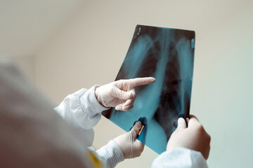 Doctors standing on white background examine x-ray for pneumonia of a Covid-19 patient in the...