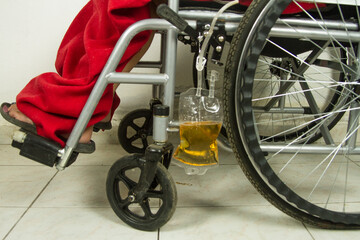 close up disabled person in a wheelchair in a hospital or clinic to which the urine catheter drainage bag is attached which is filling with urine