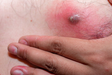 The inflammation of the swelling from abscess on the chest of asia man.
