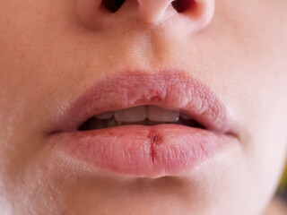 Close-up pale female lips cracked from frost, wind, lack of vitamins. Herpes disease virus wound. Lips need hygiene. Mature woman 35 years oldsuffering from herpes