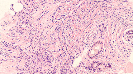 Breast cancer histology (biopsy): Microscopic image (photomicrograph) of an infiltrating (invasive) lobular carcinoma, detected by screening mammogram. H & E stain.