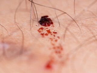 Macro photo of a dried blood on human skin, extreme close up of dry blood on skin.