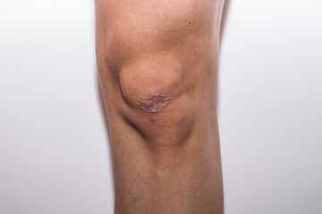 close up of a person with a scar on the knee