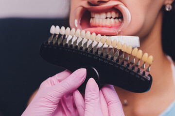 The dentist comparing patient's teeth shade with samples for bleaching treatment.