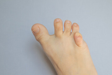 Contacting a specialist. Wry foot, crooked toes, disability, wrong body parts.