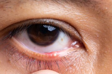 Fototapeta premium Close up of woman patient's infected eye. .Purulent eyes at right loer eyelid