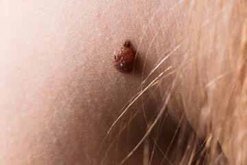 Closeup brown mole on caucasian woman skin.