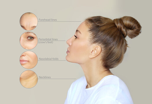 Effects of ageing,Frown/scowl lines ,Nasolabial folds,Neck ,Under eye circles,neck lines. Plastic Surgery Results