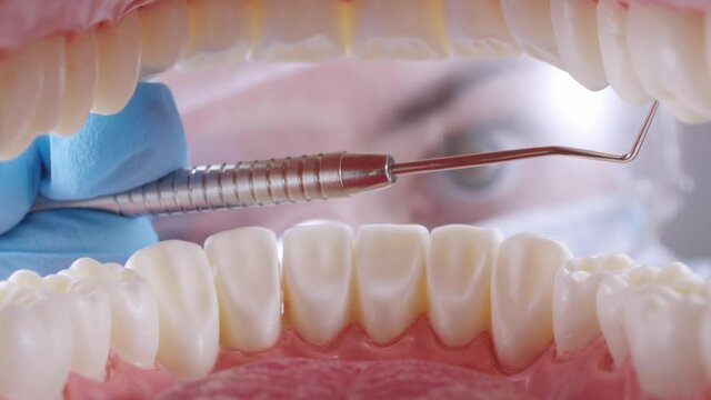 Dentist in glasses, protective mask and blue gloves inspects patient's teeth with probe before curing. View inside of mouth. 4k 50 fps