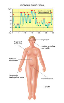 Illustration of a woman with a swollen body due to fluid retention caused by idiomatic edema, a list of the symptoms, and a graph showing the daily weight changes over a month, caused by the edema.
