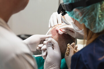 Hair transplantation is a surgical technique that moves hair follicles from a part of the body...