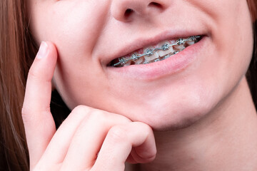 Happy smile of young woman with dental braces