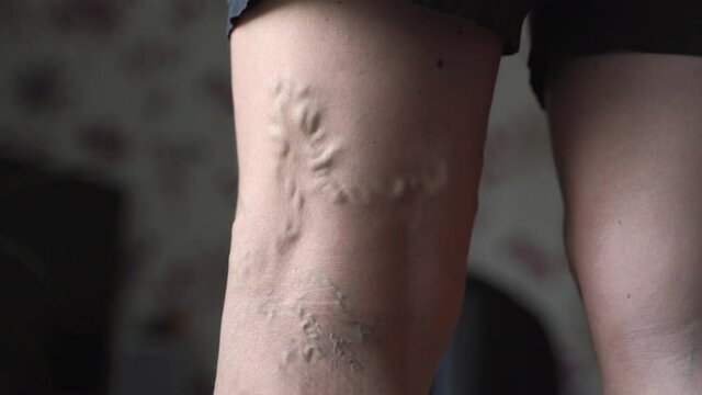 Varicose veins on woman legs indoors. Vascular health problem. Trombose on female legs