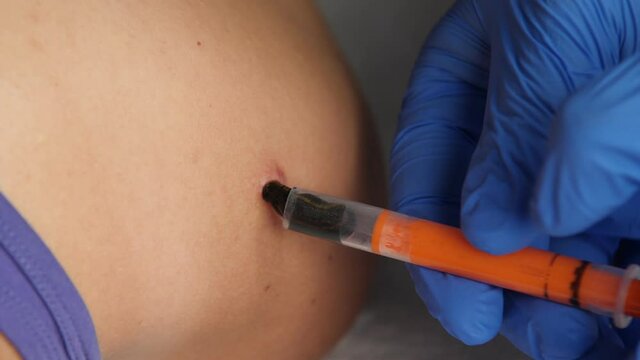 A doctor's hand in a medical glove puts a leech with a syringe on the scar on the shoulder close-up. The leech sticks to the patient's skin.