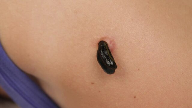A suckled leech on a scar sucks blood in close-up. Procedure for removing scars.
