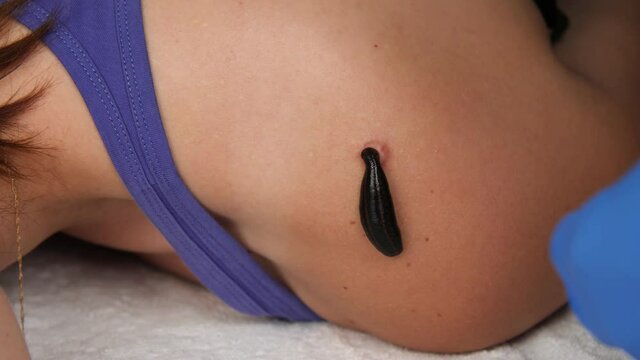 A doctor's hand in a medical glove touches a swollen leech attached to the human body. A swollen, dry leech.