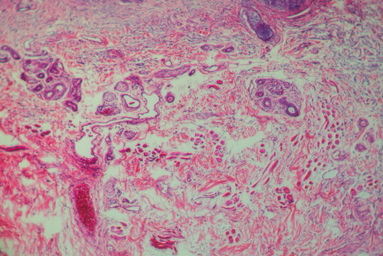 human cells, basal cell cancer of eyes