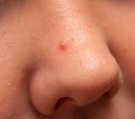 inflamed acne on the nose