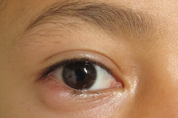Outer view of nodule shaped style- chalazion on the lower eyelid of child. Papilledema ,Blepharitis...